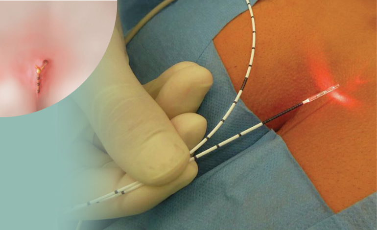 best laser Pilonidal Sinus Surgery in surat
